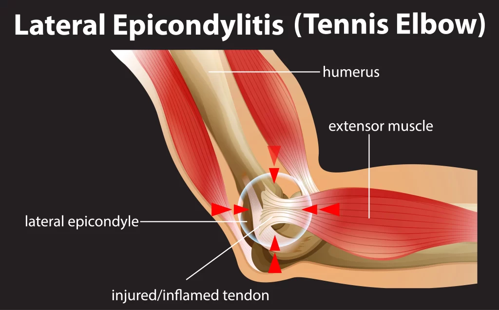 Tennis Elbow Pain